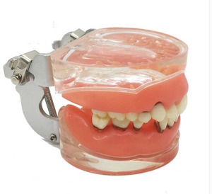 IP0017  치과 치아 이빨 이 잇몸 충치 모형