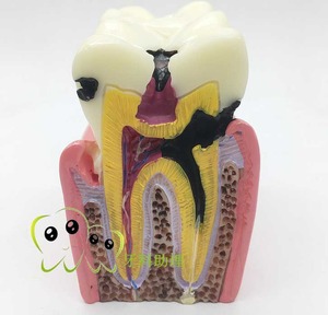 IP0014  치과 치아 이빨 이 잇몸 충치 모형