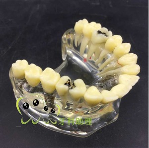 IP0025  치과 치아 이빨 이 잇몸 충치 모형