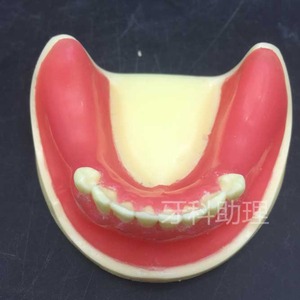 IP0022  치과 치아 이빨 이 잇몸 충치 모형